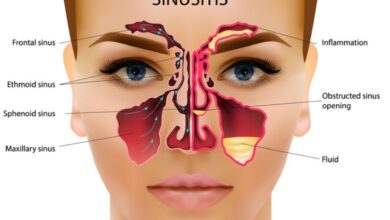 How Stress and Chronic Sinusitis Are Connected: Strategies for Relief